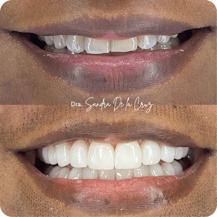 Rehabilitación estética avanzada