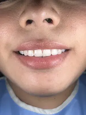 Caso 1 de tratamiento de sonrisa antes