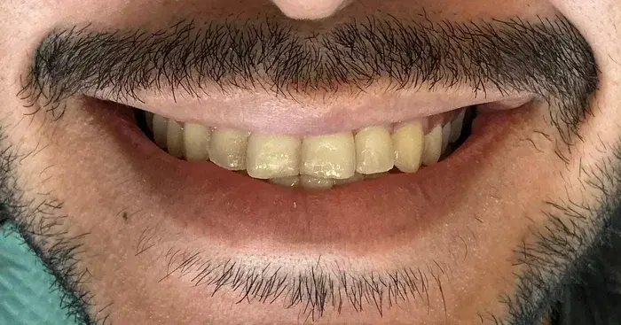 Caso 2 de tratamiento de sonrisa antes