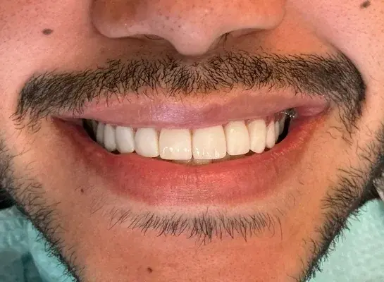 Caso 2 de tratamiento de sonrisa despues