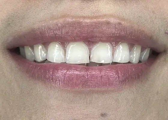Caso 3 de tratamiento de sonrisa antes