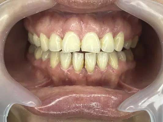 Caso 4 de tratamiento de sonrisa antes