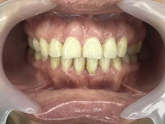 Caso 4 de tratamiento de sonrisa despues