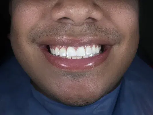 Caso 5 de tratamiento de sonrisa despues