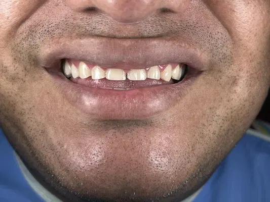 Caso 6 de tratamiento de sonrisa antes