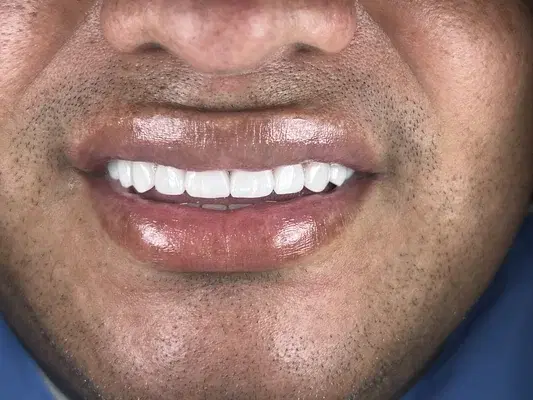 Caso 6 de tratamiento de sonrisa despues