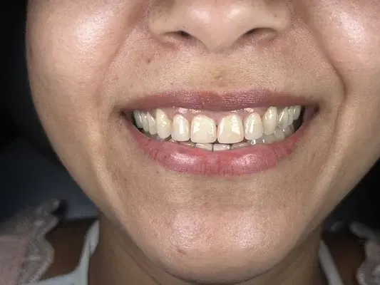 Caso 7 de tratamiento de sonrisa antes