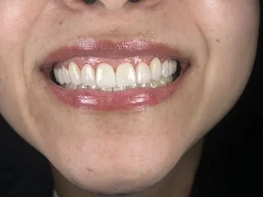 Caso 7 de tratamiento de sonrisa despues