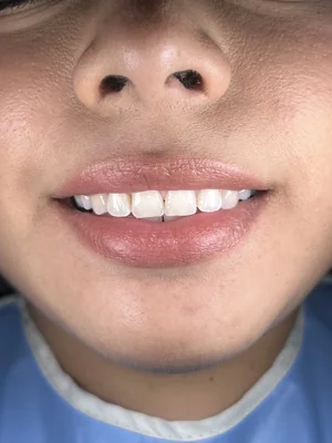 Caso 1 de tratamiento de sonrisa antes
