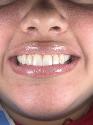 Caso 1 de tratamiento de sonrisa después