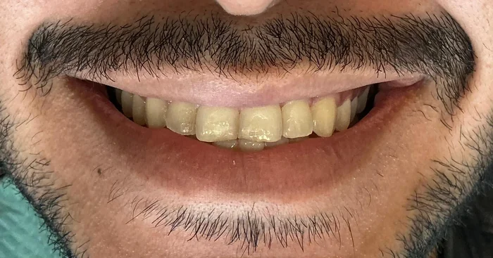 Caso 2 de tratamiento de sonrisa antes