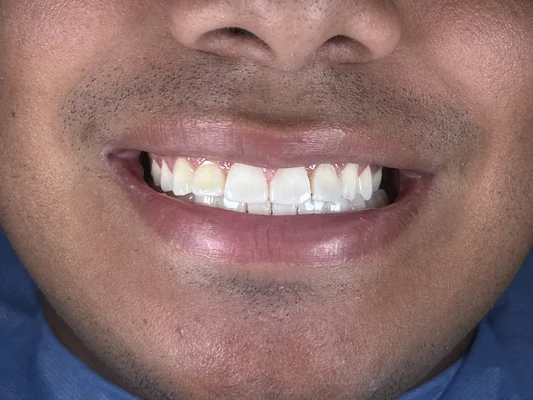 Caso 5 de tratamiento de sonrisa antes