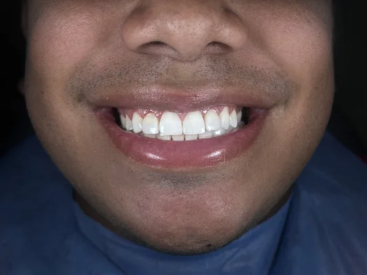 Caso 5 de tratamiento de sonrisa después