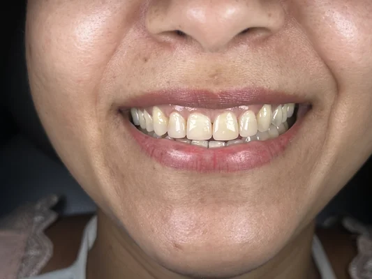 Caso 7 de tratamiento de sonrisa antes